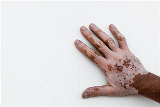 effective vitiligo treatments