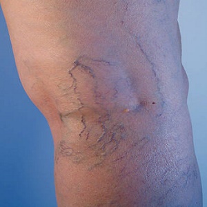 What are the Symptoms of Vein Disease?