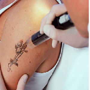 How Many Tattoo Removal Treatments will I need
