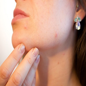 How Can I Eliminate The Appearance of Acne Scars?